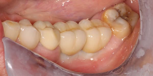 patient Missing back teeth replaces with 2 dental implants