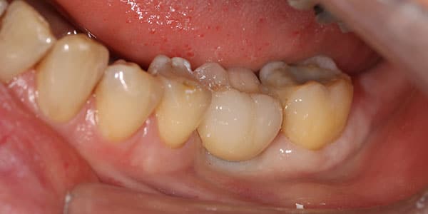Missing back tooth replaced with an Dentist implants